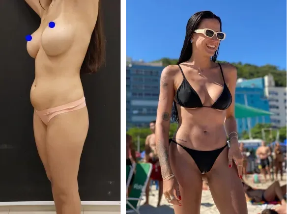 Results of abdominoplasty with Dr. Alexandre Charão in Rio de Janeiro