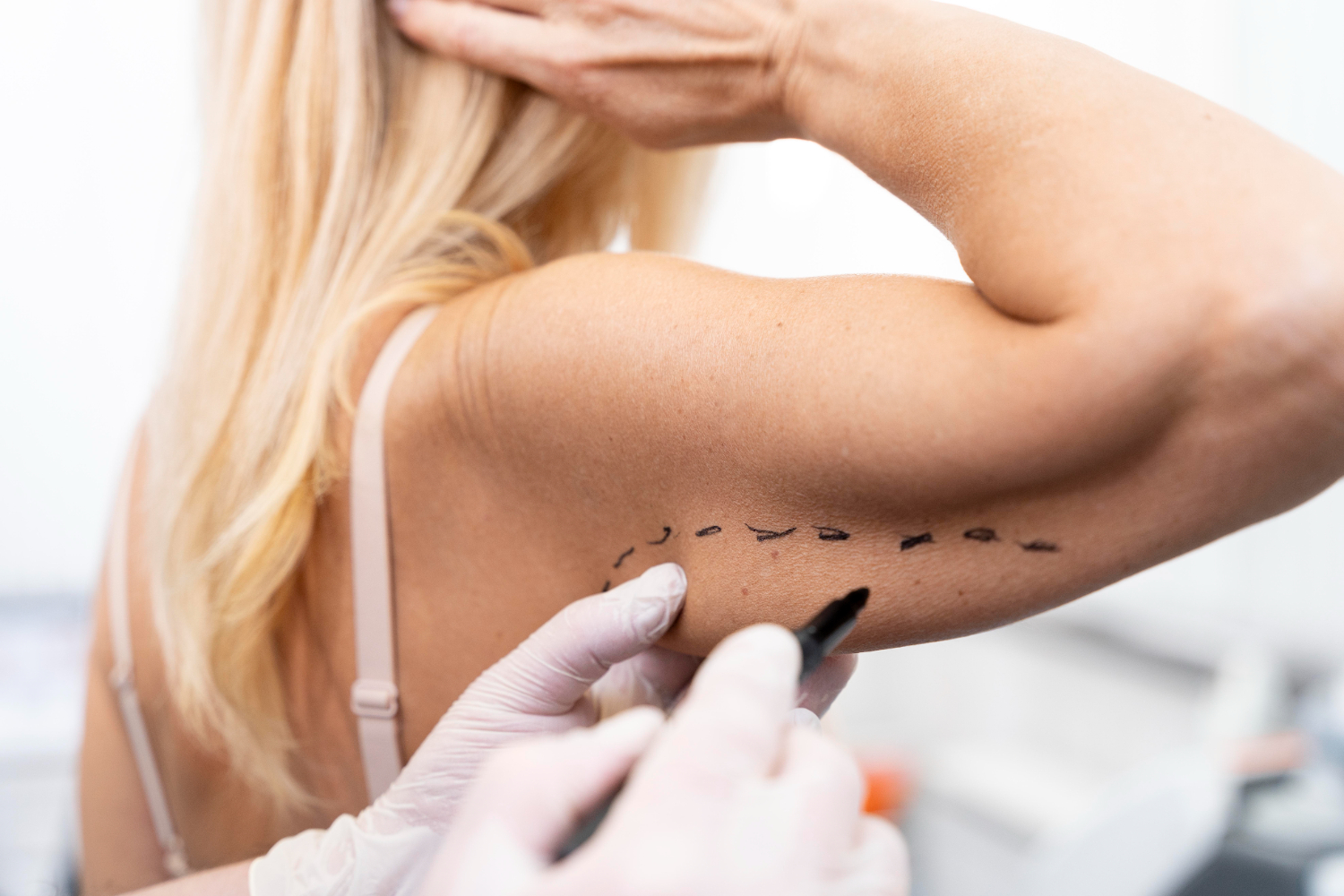 Arm Lift Surgery