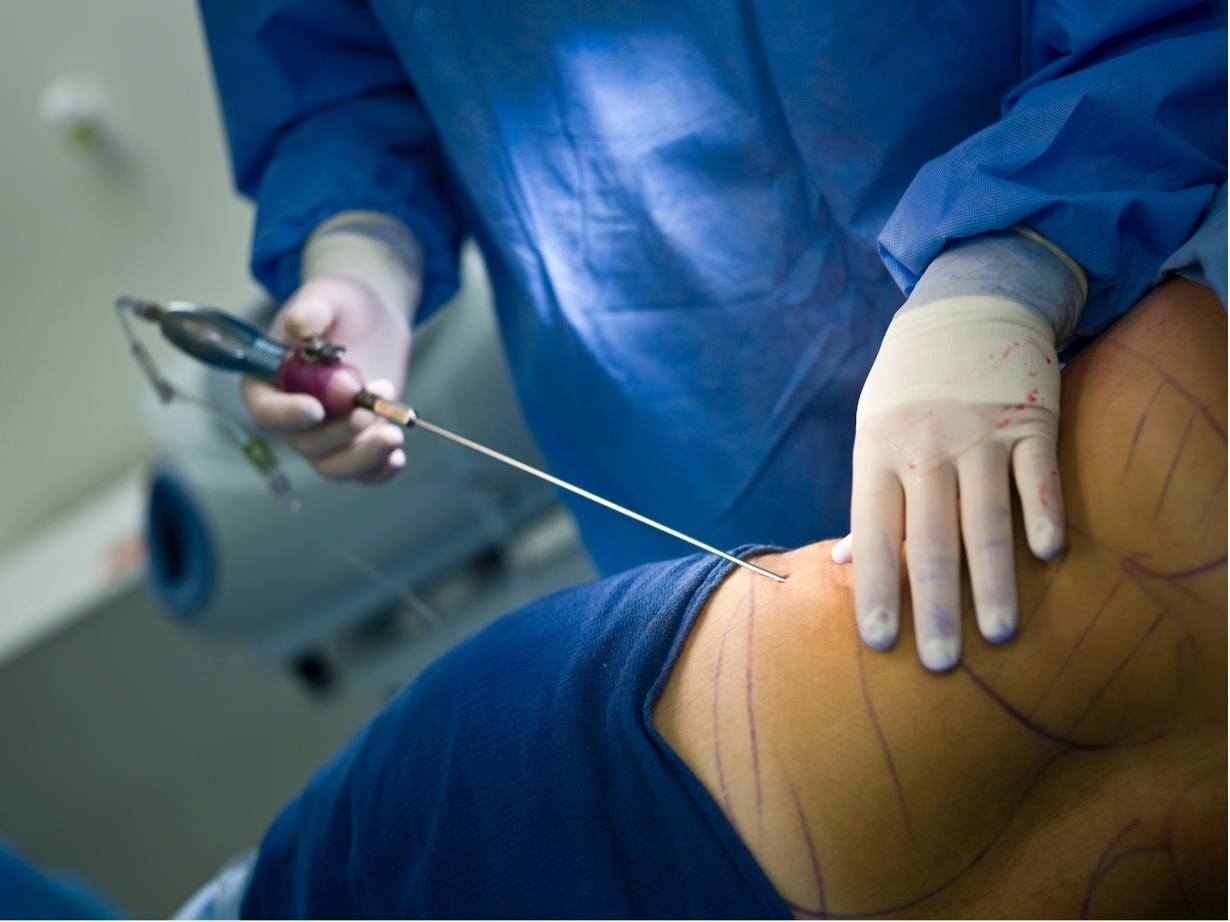 Liposuction in Rio de Janeiro