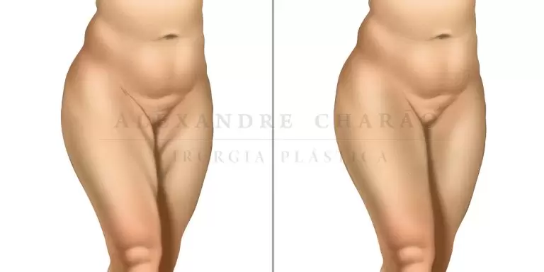 thigh lift surgery