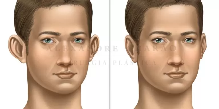 Otoplasty in Rio de Janeiro